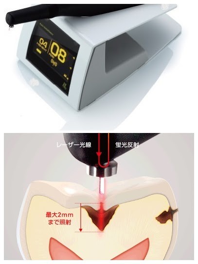 光学式う蝕検出装置（ダイアグノデントペン）