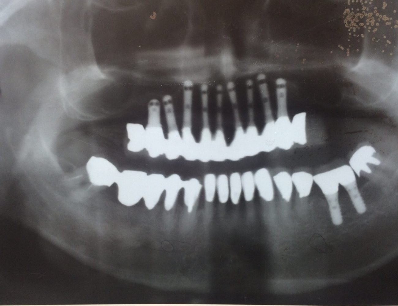 失った歯を自然な形で取り戻す治療としてインプラント治療に力を入れています。