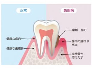 薬で歯周病の症状を改善する歯周内科的治療法を取り入れています。