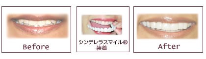 自宅で手軽に理想の白さを追求、負担を抑えて輝く笑顔を導くホームホワイトニング