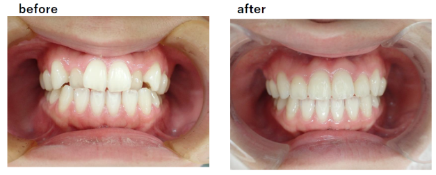矯正治療の症例