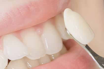 セラミックの詰め物や被せ物で自然な見た目を提供します