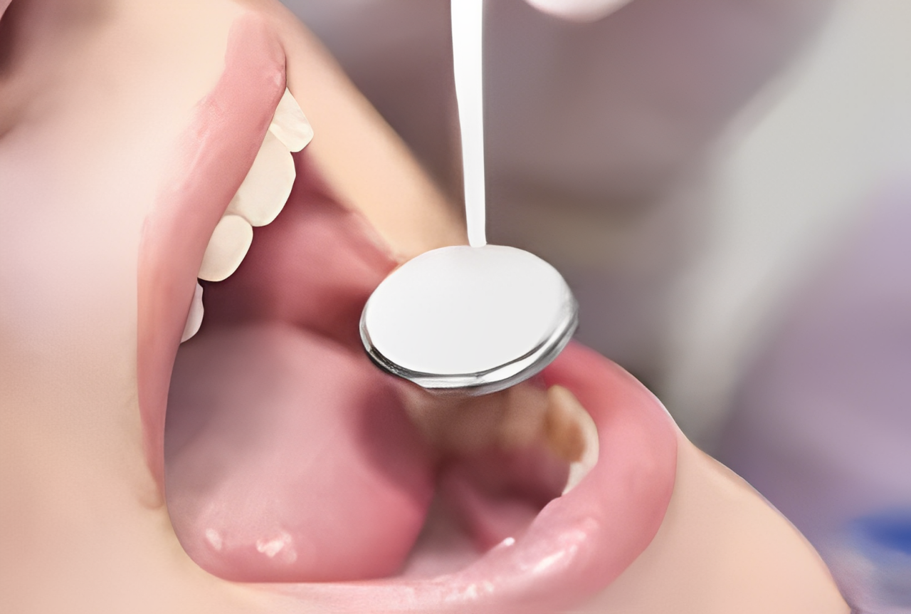 神経まで達した虫歯についての根管治療