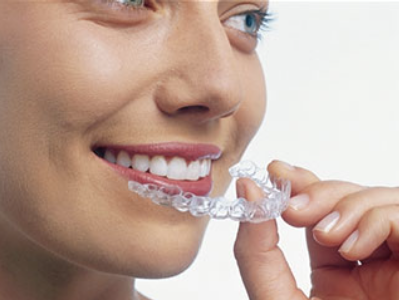 マウスピース矯正の様子