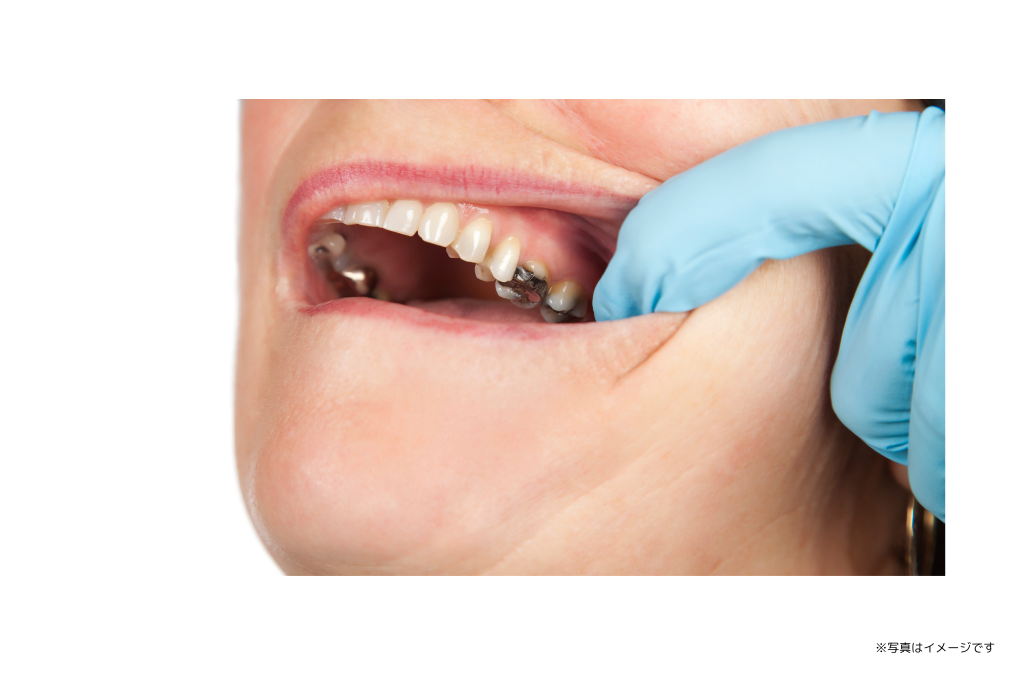 金属アレルギーのリスクに配慮したかぶせ物や義歯の治療を提供しています