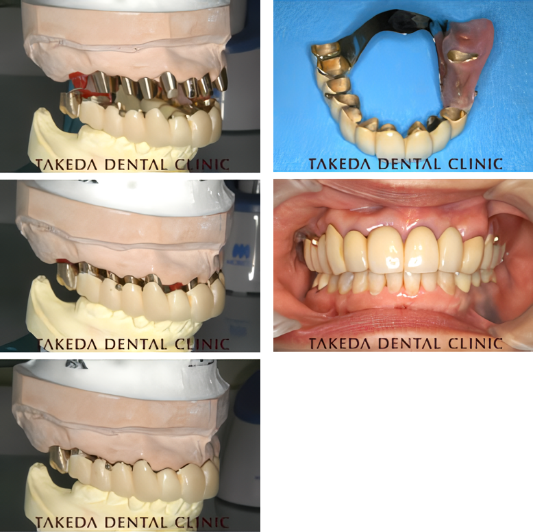 入れ歯製作の過程です