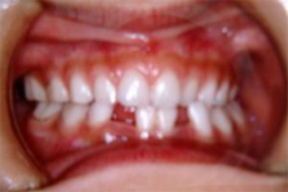 成長段階にある小児から成人まで幅広く矯正歯科に対応しています