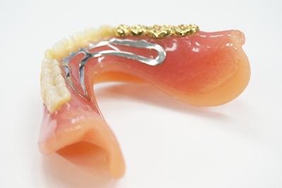 入れ歯・義歯治療には多様な選択肢があり、患者様の状態やご希望に合わせた治療法を提案しています。