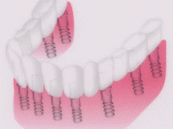 健康な歯に近い感覚を求める方にとって、インプラントはより適した選択肢といえます
