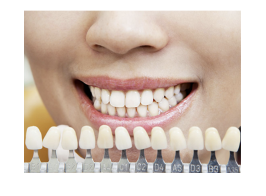 お口の中から金属色を取り除き、自然で美しい仕上がりを提供しています