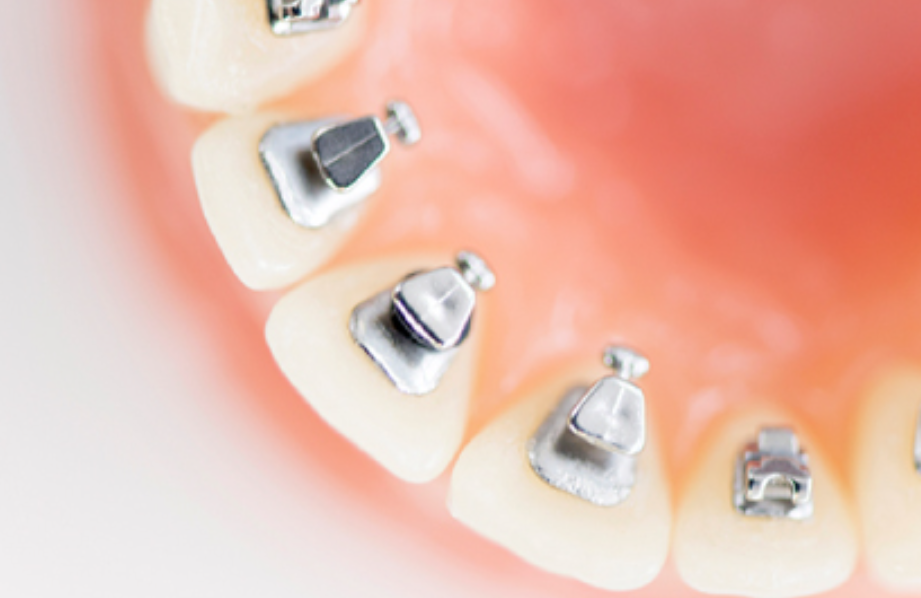 完全オーダーメイドの裏側矯正で目立たずに歯並びを整える専門治療