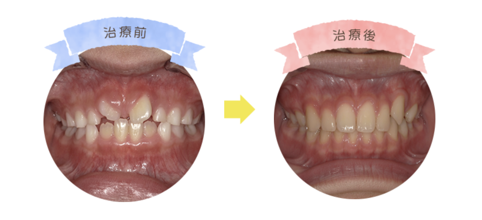 前歯の矯正症例