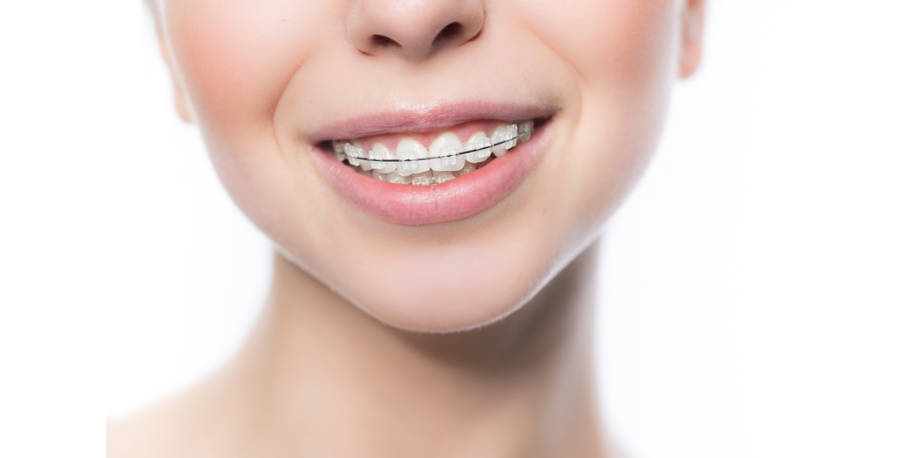 銀座みゆき通りデンタルクリニックの矯正治療では、健康な歯を可能な限り残すことを重視しています