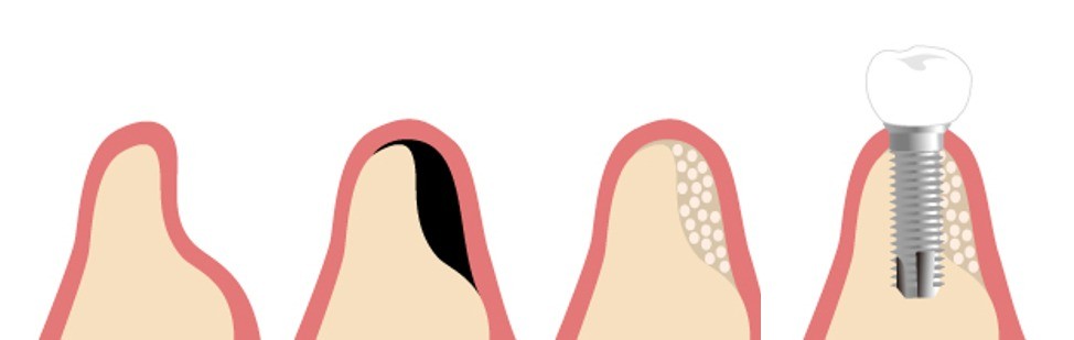 口腔状態や生活背景を踏まえ、将来を見据えたインプラント治療を提案しています。