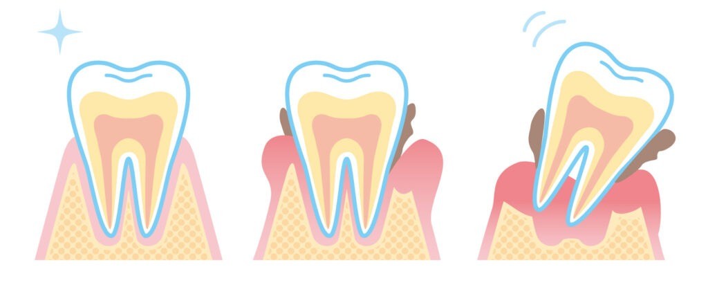 歯周病は悪化すると元の状態に戻すことが難しいため、早期発見と継続的な管理により進行を抑えることが重要です。