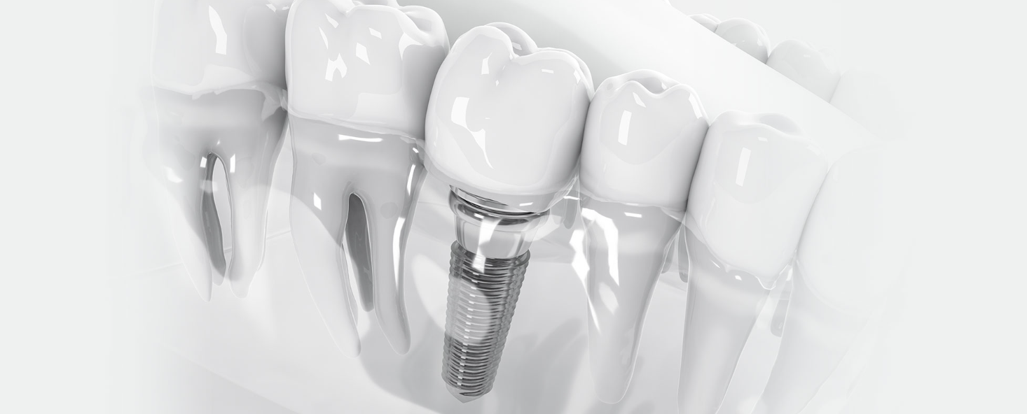 患者さまが再び笑顔で生活できるようインプラント埋入治療を提供しています