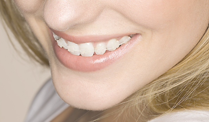 目立ちにくいワイヤー矯正もご用意しております