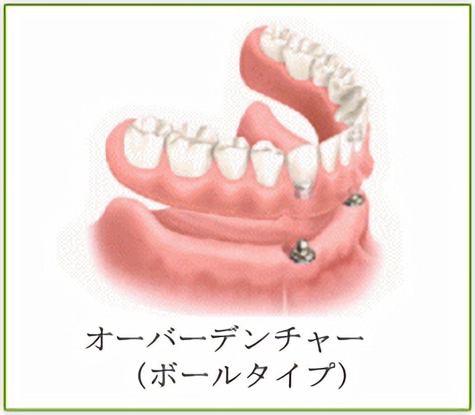 オーバーデンチャー