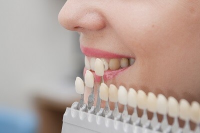 最適なホワイトニング方法をご提案します