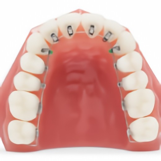 リンガルブラケット矯正装置