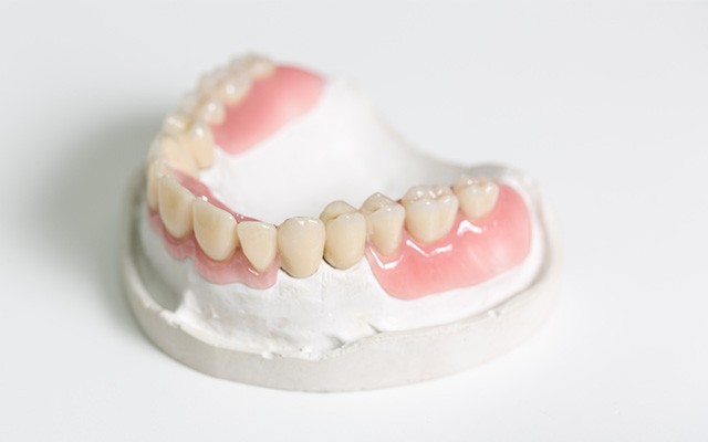 ノンクラスプデンチャー