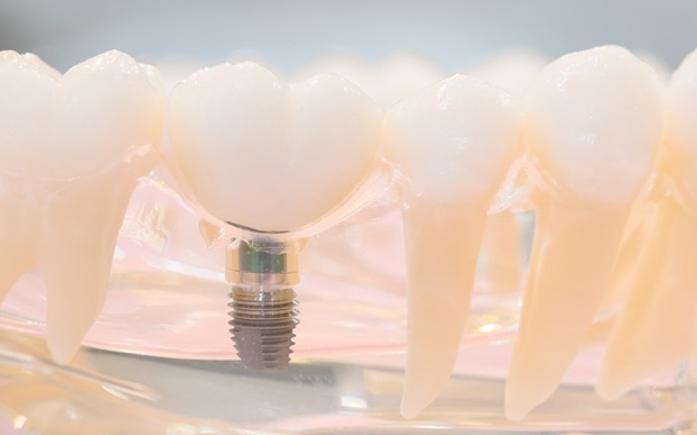 インプラントなら、天然の歯に近い感覚でしっかりと噛むことができます