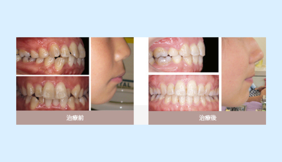 横顔にも自信を持てる矯正治療