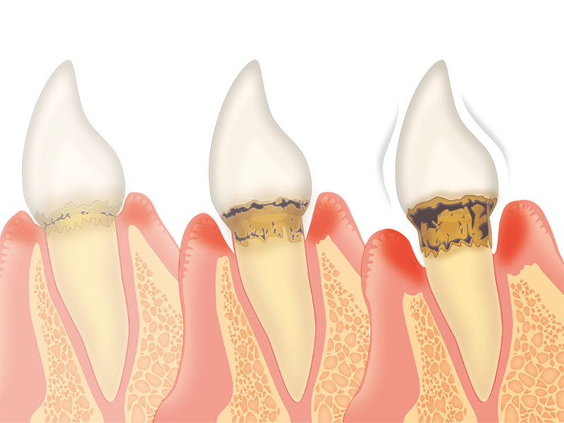 最後には歯を失ってしまうことになるためこまめな検診により治療を行いましょう