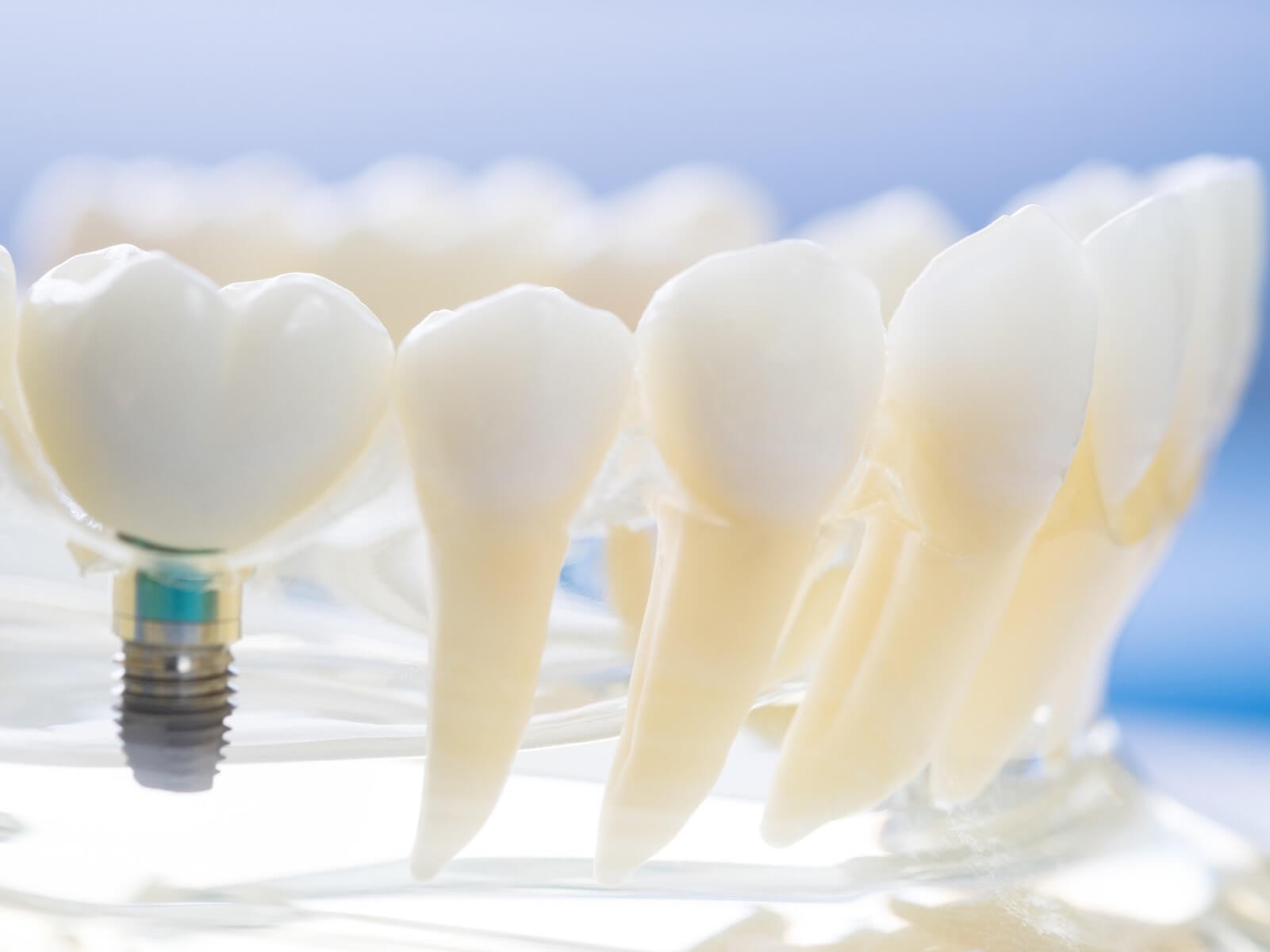 自分の歯のような自然な噛み心地を望む方に適した治療としてご案内しています