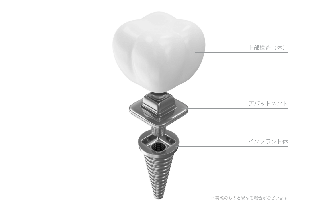 長く安心して噛めるインプラント治療のご提案
