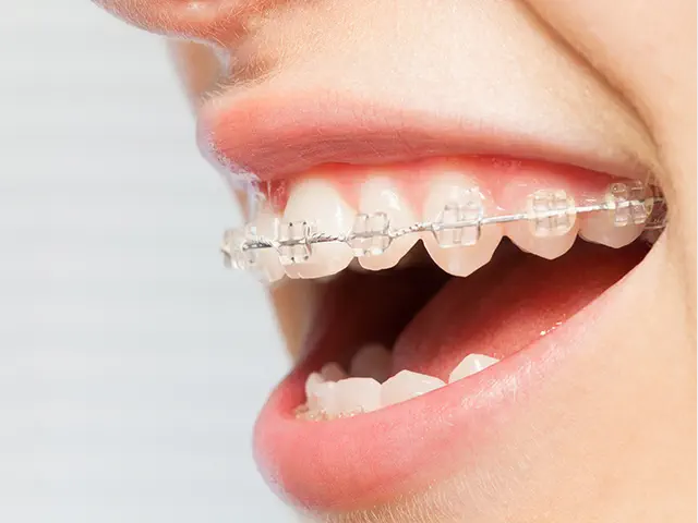 歯並びを整えると、歯周病の予防にもなります。