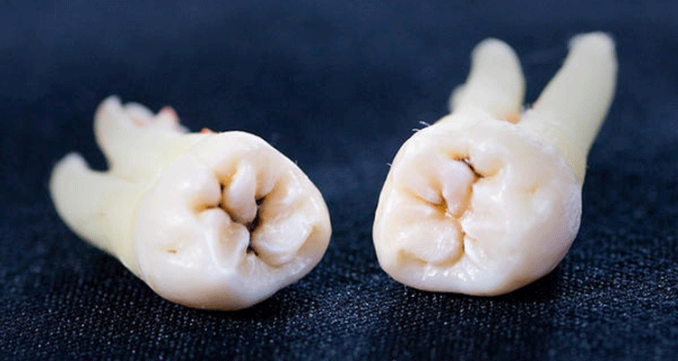 親知らずの抜歯もご相談ください