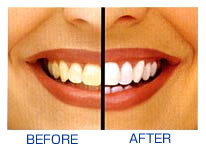 白く美しい歯を作ります