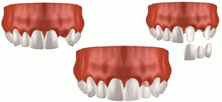 患者様のお口の中の症状に合わせたインプラント治療を提供します