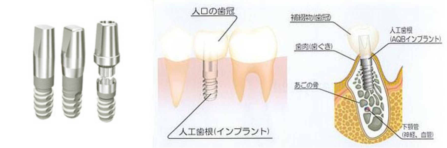 成功率の高いインプラント治療
