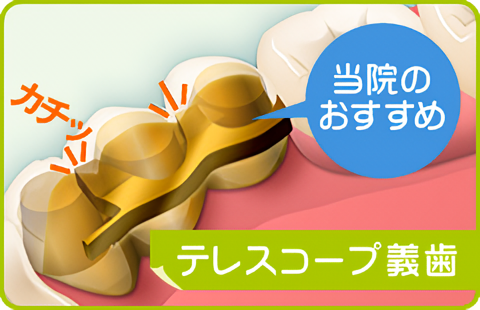 加齢や虫歯、歯周病、事故など、さまざまな原因で歯を失った際、多くの方が選択するのが入れ歯です。