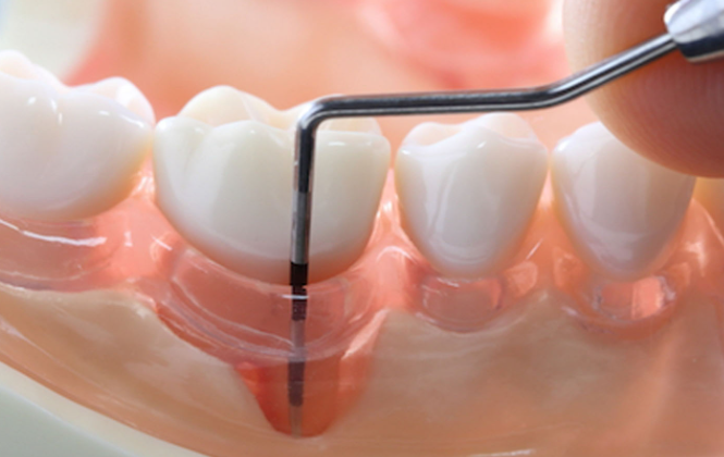歯周病の治療から予防までおまかせください