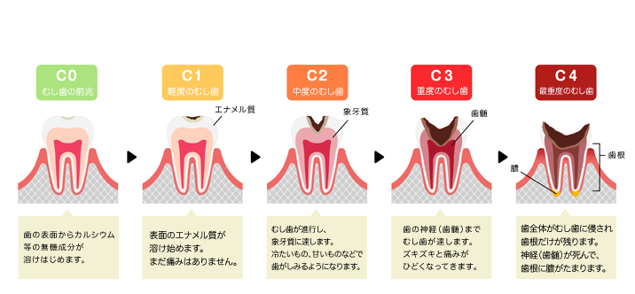 むし歯は早期発見・早期治療が重要です