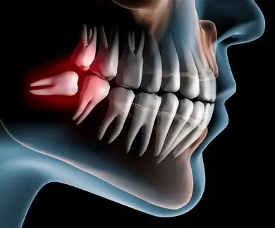 早めの抜歯で歯の健康を維持