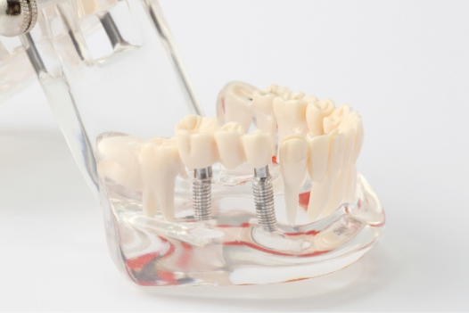 最新の技術を用いて、患者様に最適なインプラント治療を提供しています。