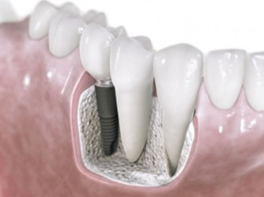 スウェーデン製のアストラテックインプラントシステム（デンツプライ）を使用しております