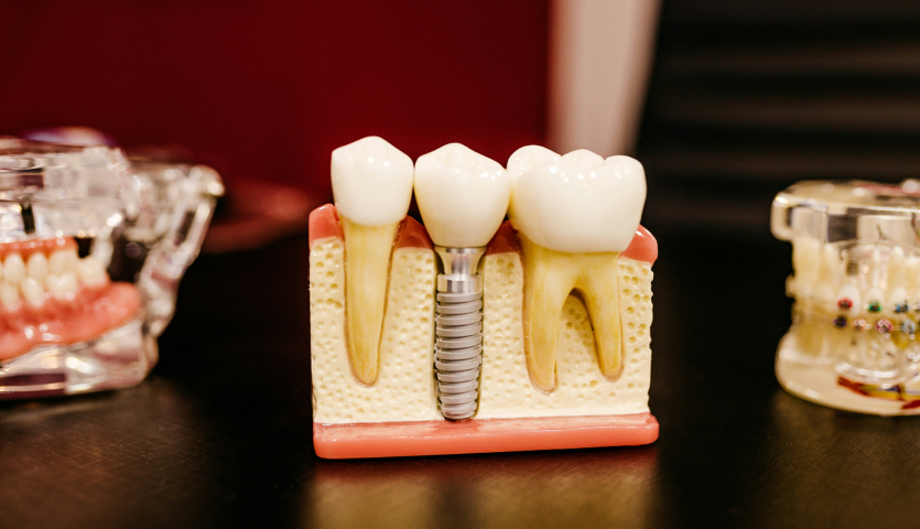 長期安定を目指す高品質なインプラント治療