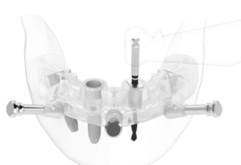 安全性が高く、精度の高いインプラント治療を行います