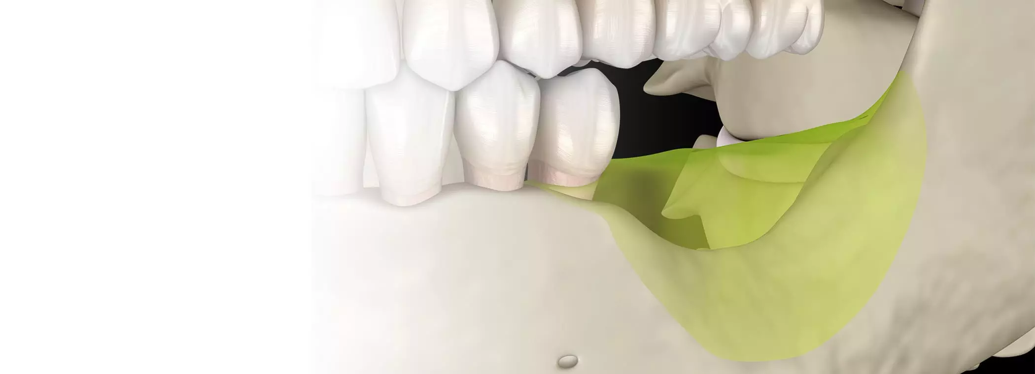 インプラント治療を行い、失った歯を取り戻すための高度な医療を提供しています