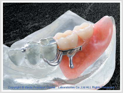 様々な入れ歯を取り扱っています