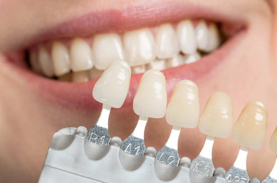自信をもたらす審美歯科