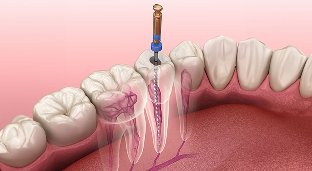 専門的な知見と精密機器で天然歯を残しています