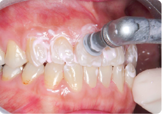 症状が出る前に専門家によるチェックを定期的に受けることで、歯の健康を維持し、将来的なリスクを減らすことができます