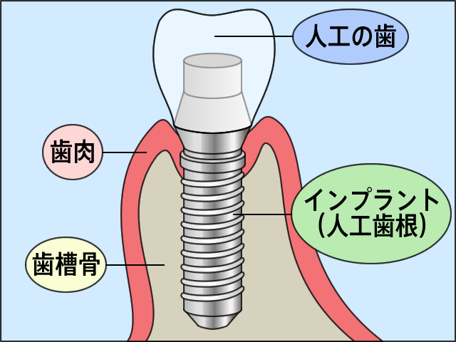 インプラントの仕組み
