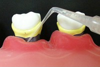 痛みの少ない虫歯治療を目指します